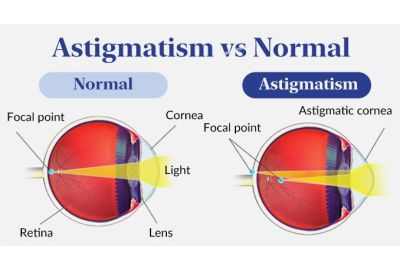 stigmatism vs astigmatism